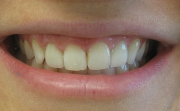 After Veneers